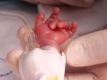 650 gr Bebeğe Yapılan Bağırsak Operasyonu Başarıyla Sonuçlandı